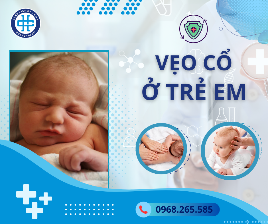 Vẹo cổ ở trẻ em